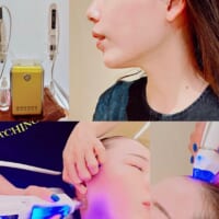 鍼を使わない美容鍼エアバリ